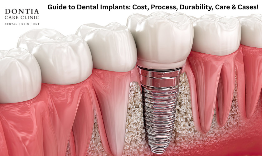 Ultimate Guide to Dental Implants
