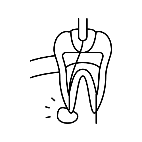 Root Canal Treatment