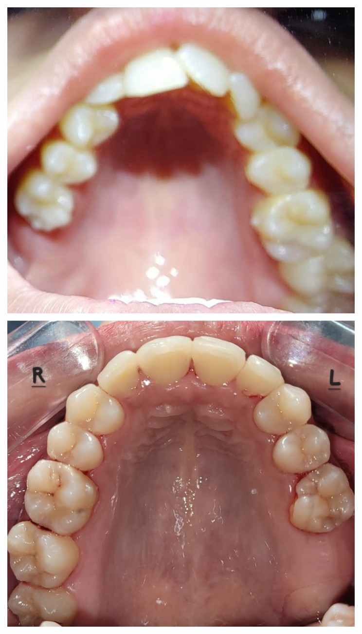 Upper arch before and after clear aligner treatment