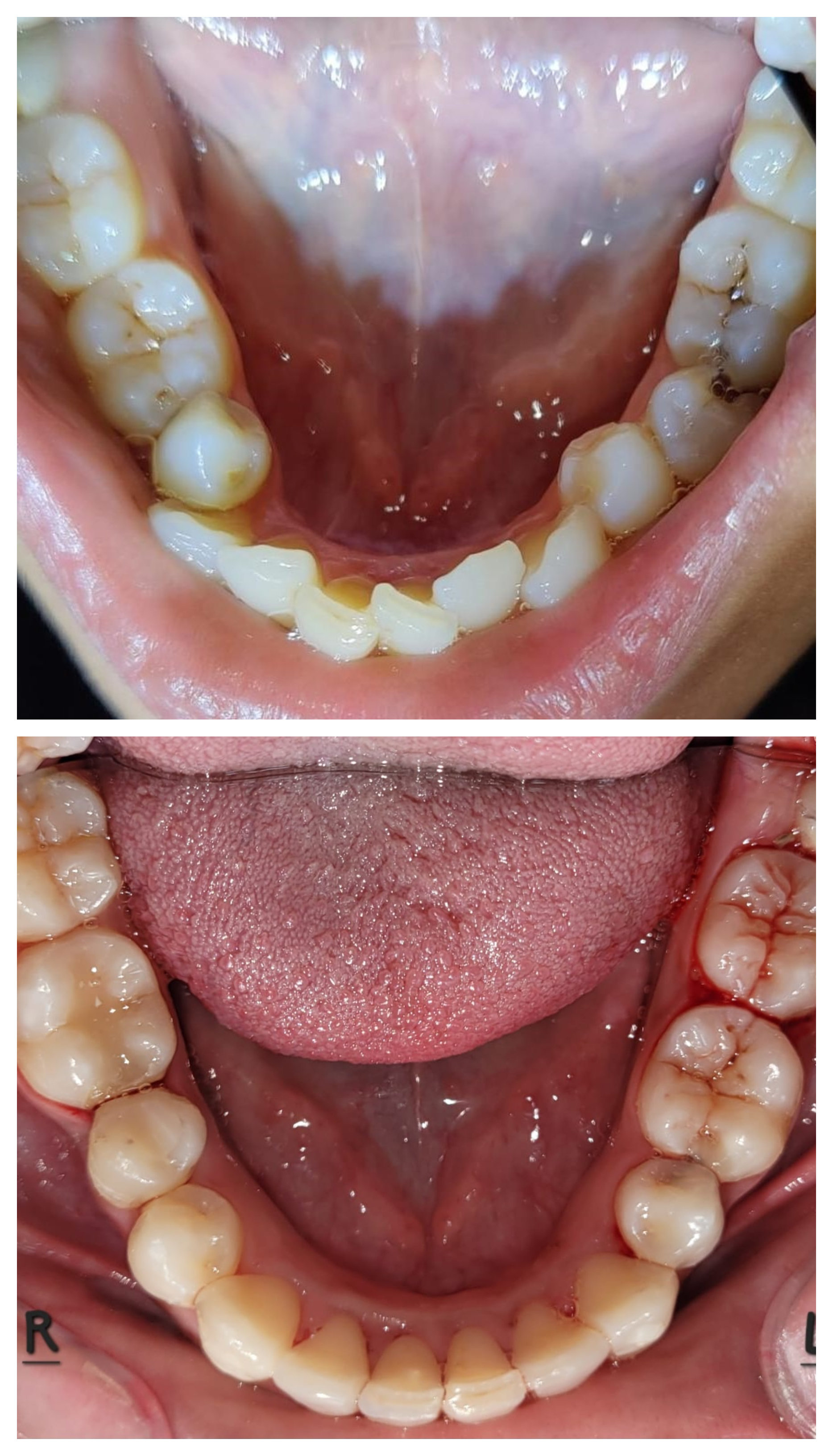 Lower arch before and after clear aligner treatment