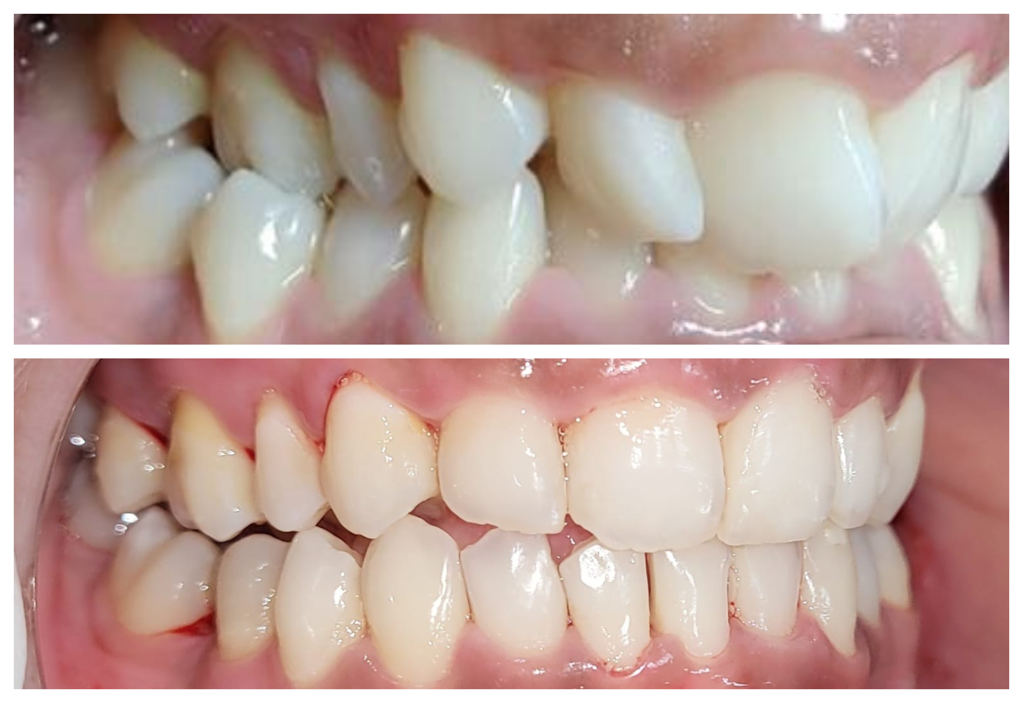 Before and after clear aligner treatment at Dontia Care Clinic, Kolkata