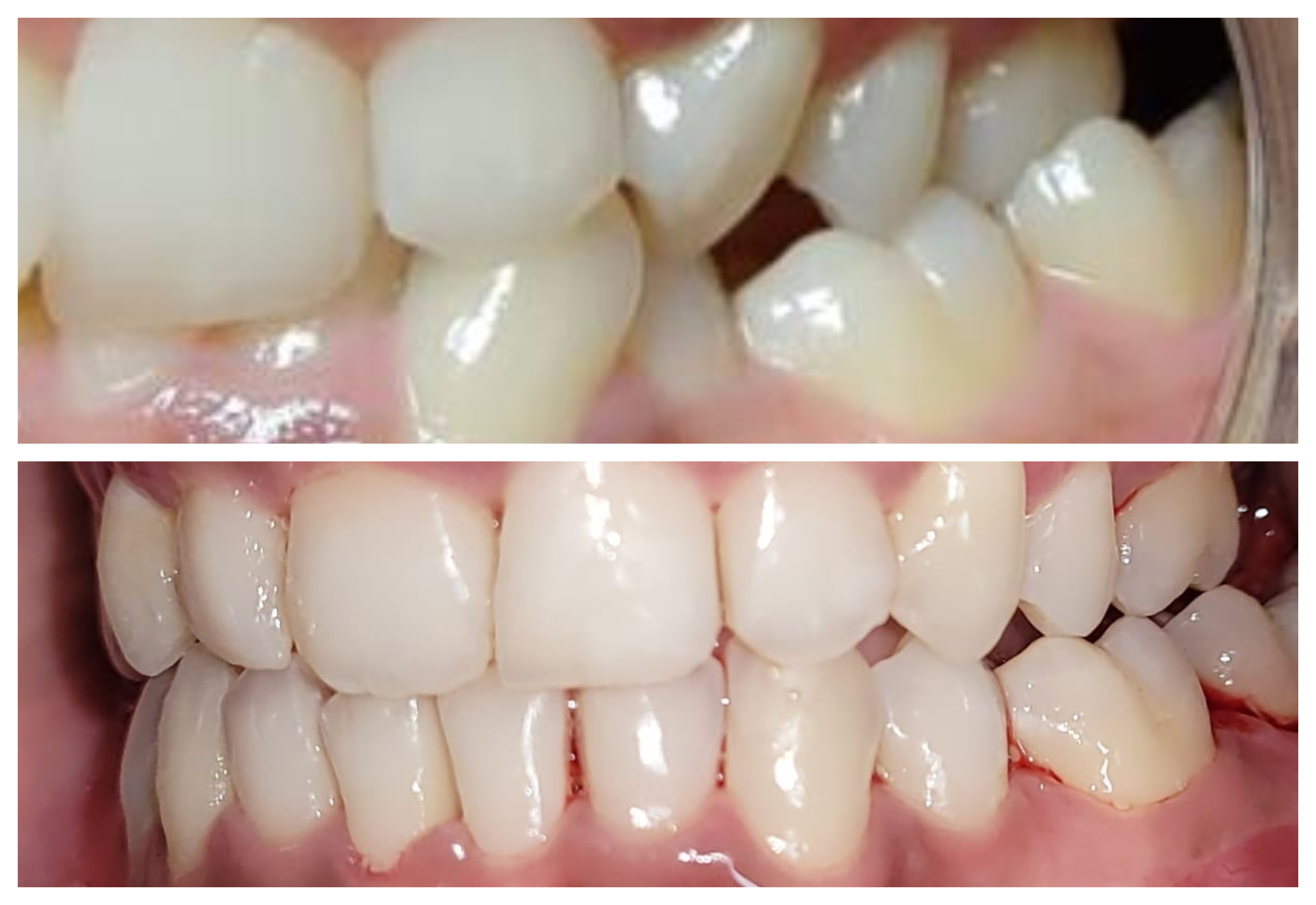 Close-up before and after clear aligner treatment