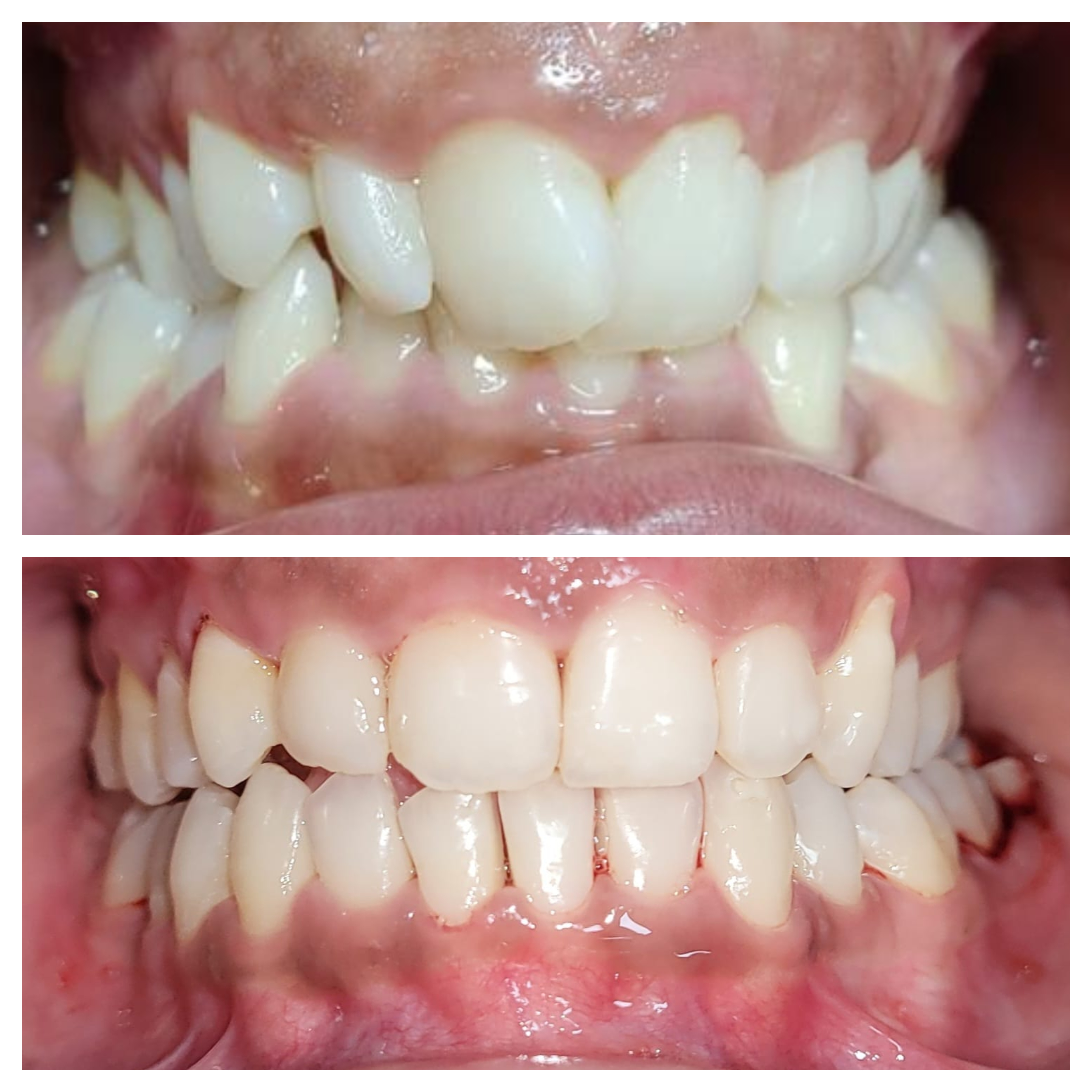 Before and after clear aligner treatment, front view, at Dontia Care Clinic