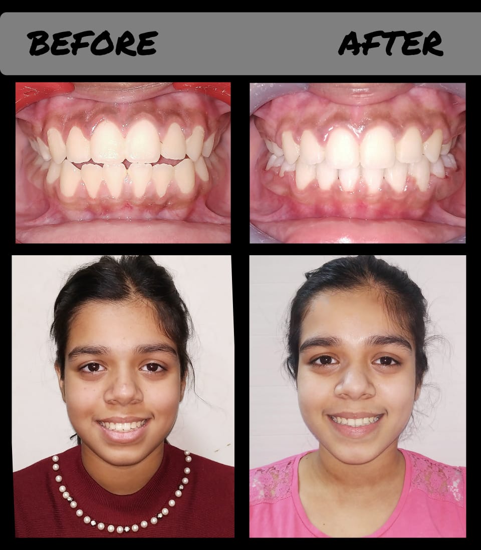 Modern cosmetic dentistry and clear aligners treatment in Kolkata