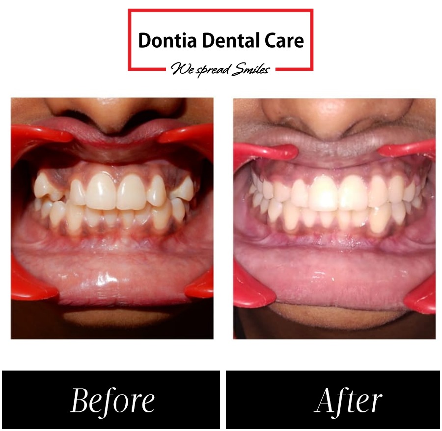 Dental veneer treatment — who is cosmetic dentistry for in Kolkata