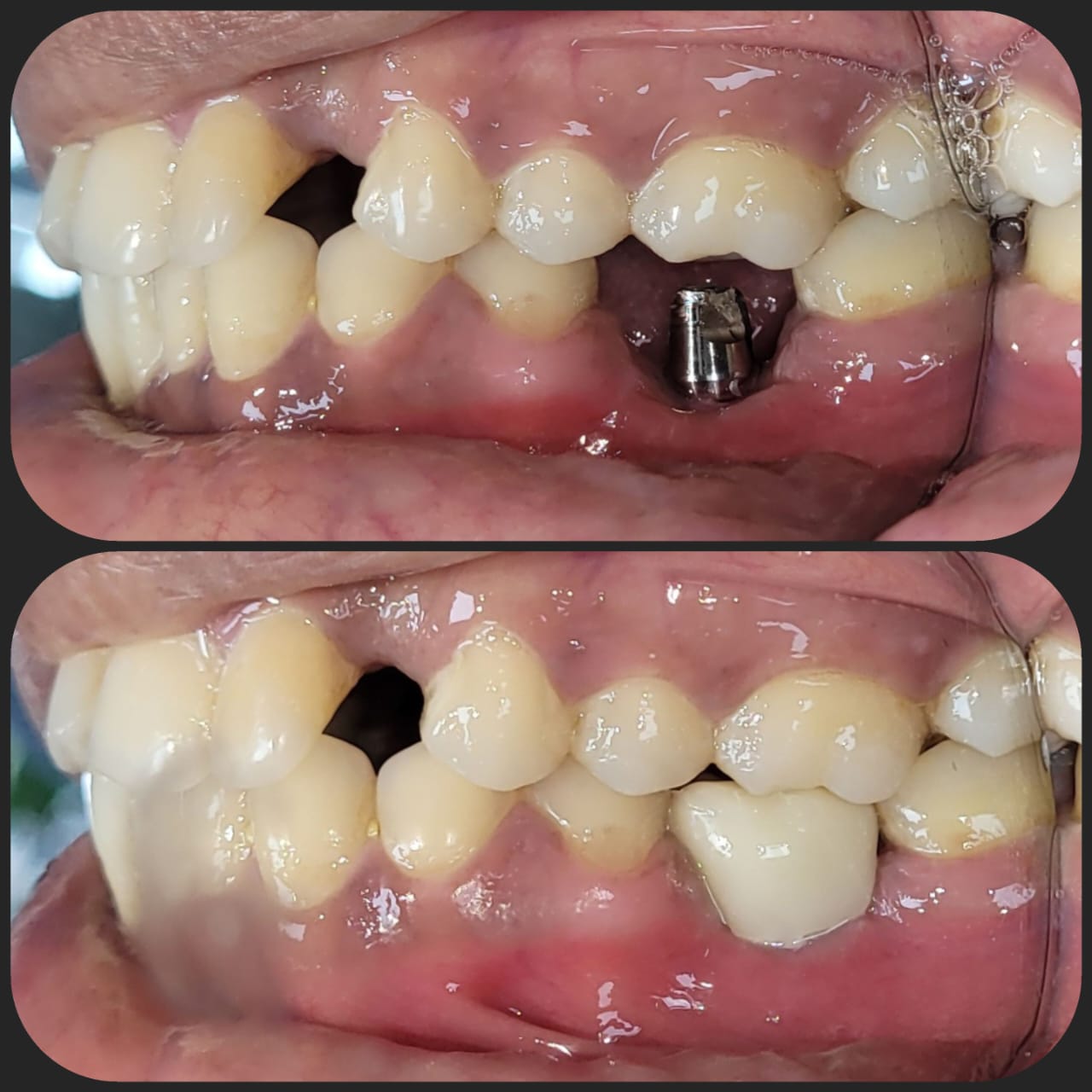 Patient story — implant treatment in Kolkata