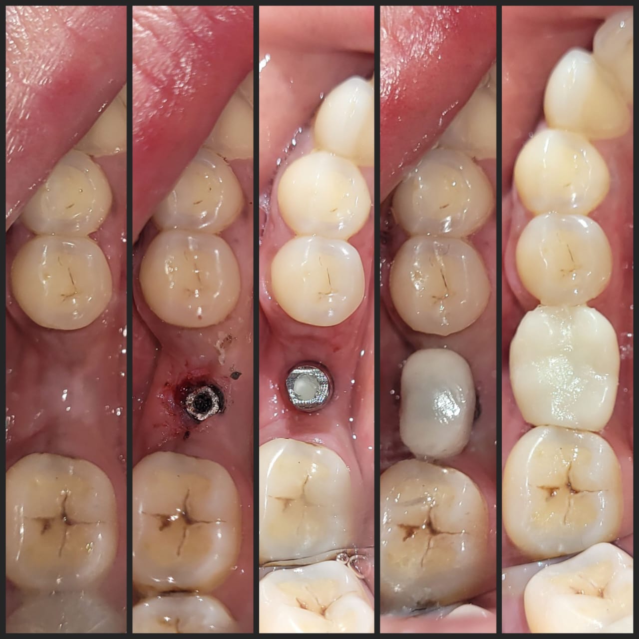 Patient story — implant treatment in Kolkata
