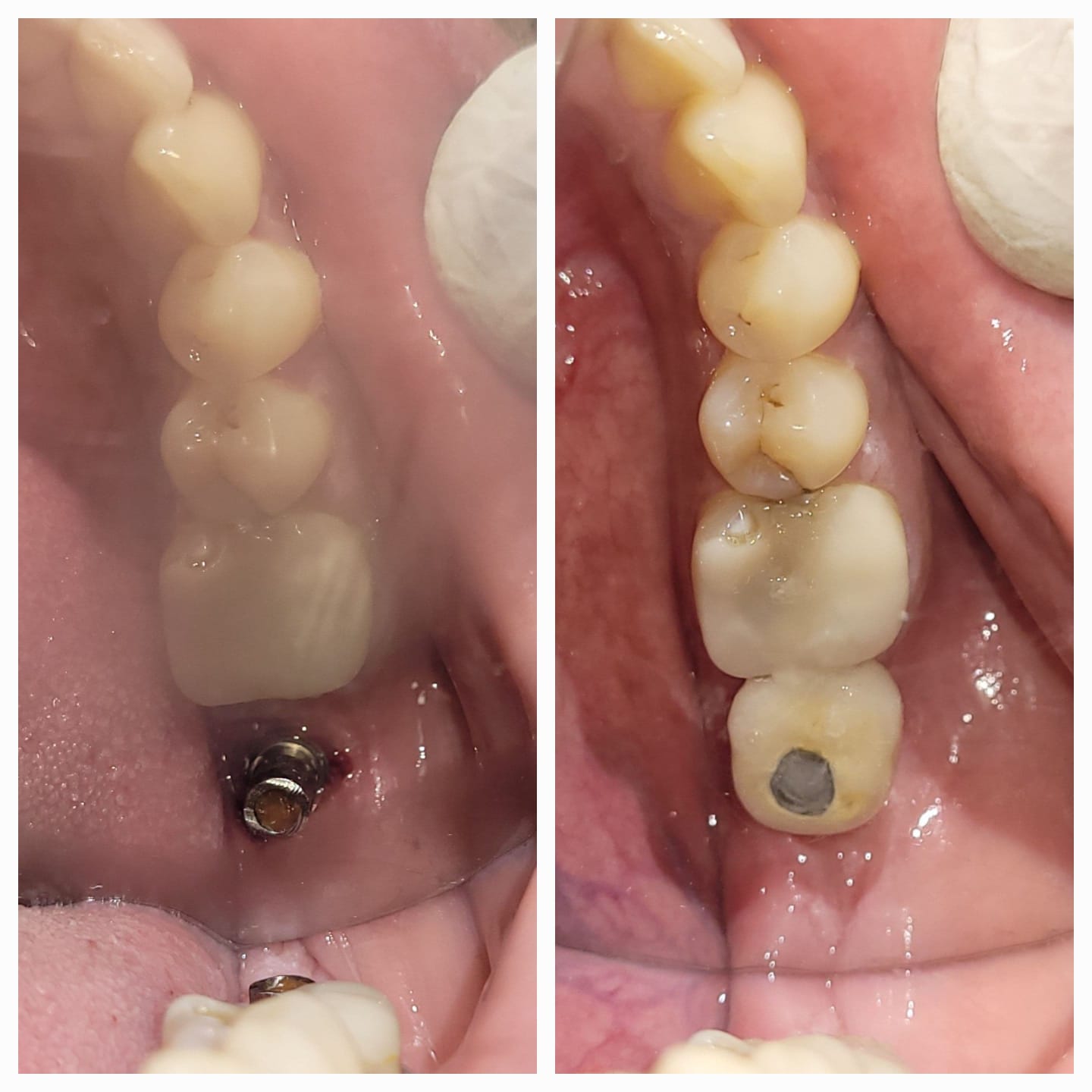 Patient story — implant treatment in Kolkata