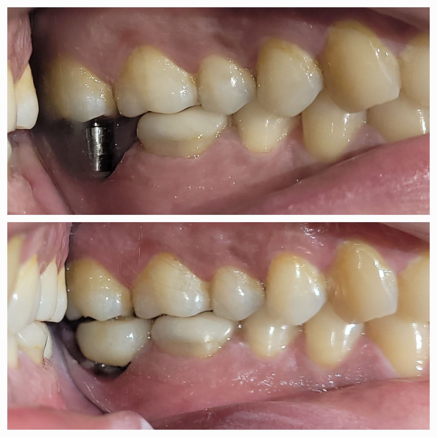 Patient story — implant treatment in Kolkata