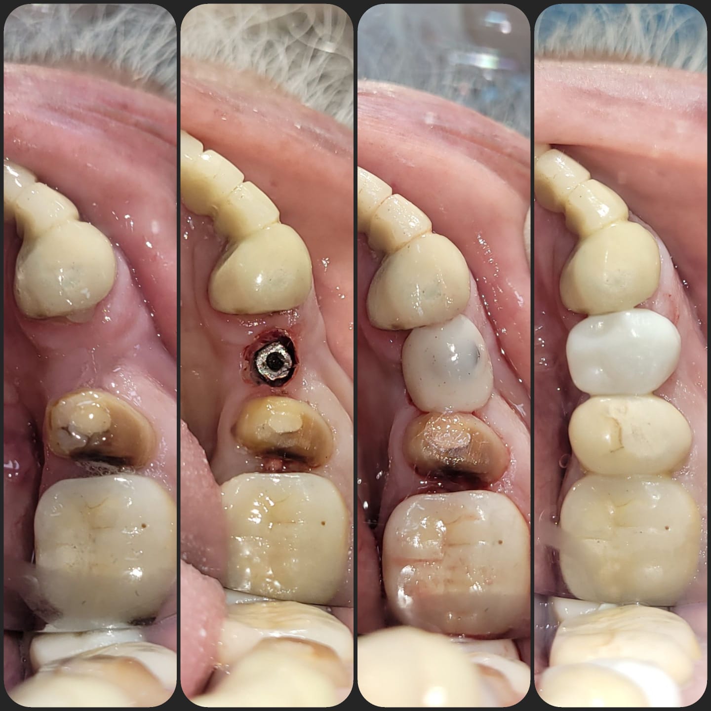 Patient story — implant treatment in Kolkata
