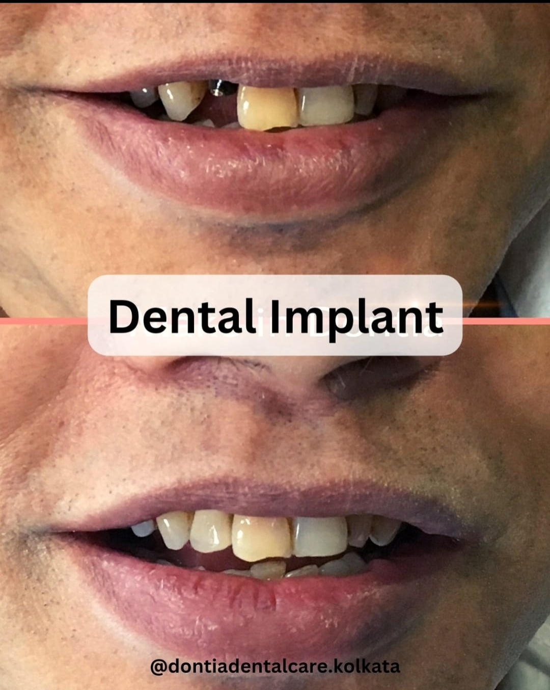 Patient story — implant treatment in Kolkata