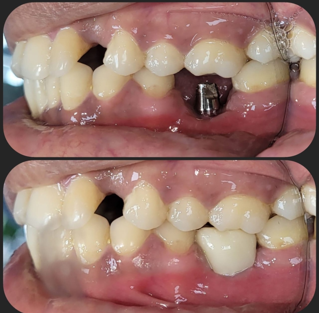 Patient story — implant treatment in Kolkata