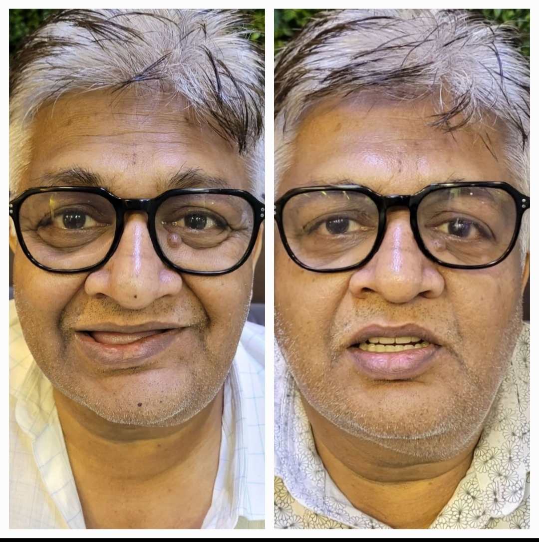 Patient story — implant treatment in Kolkata