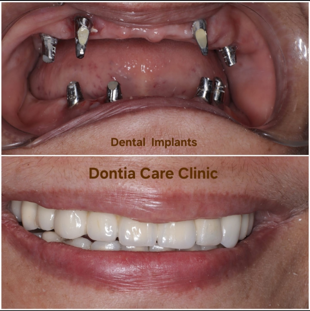 Patient story — implant treatment in Kolkata
