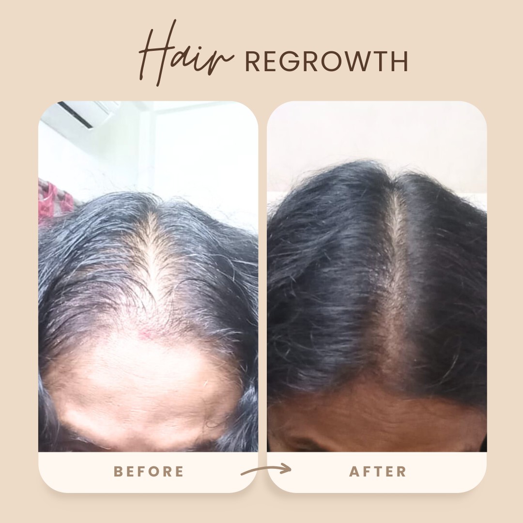 Hair regrowth before and after PRP treatment at Dontia Care Clinic Skin and Hair in Kolkata