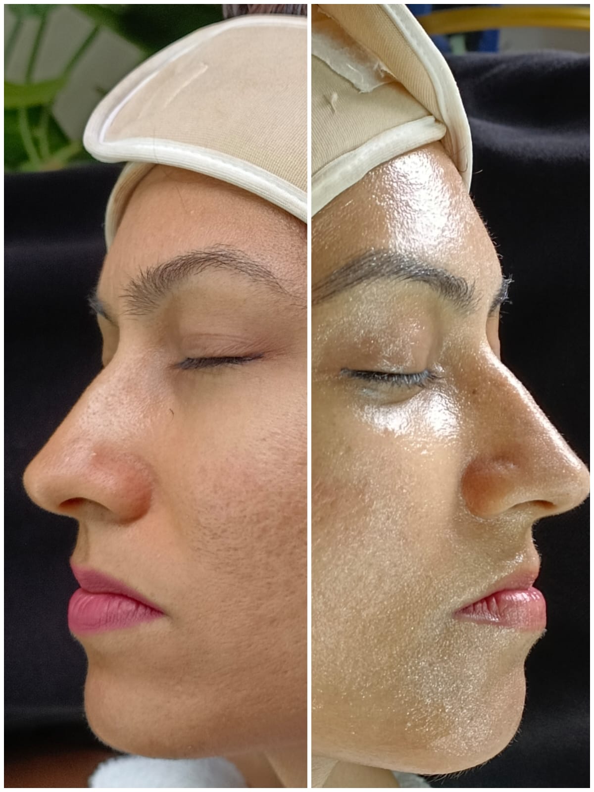 HydraFacial eye treatment before and after in Kolkata at Dontia Care Clinic