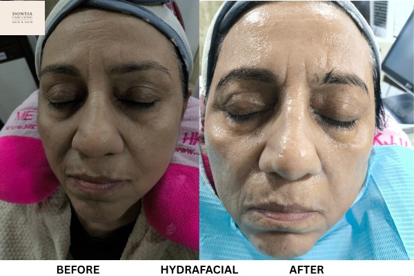 HydraFacial treatment before and after at Dontia Care Clinic Skin and Hair in Kolkata