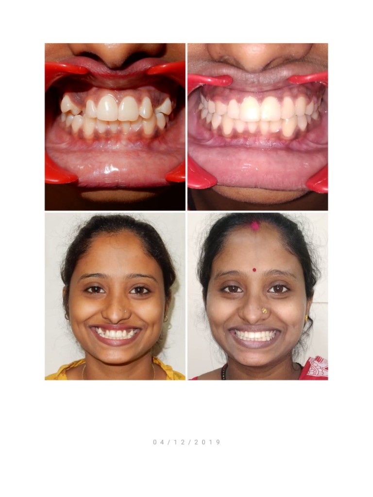 Braces treatment before and after