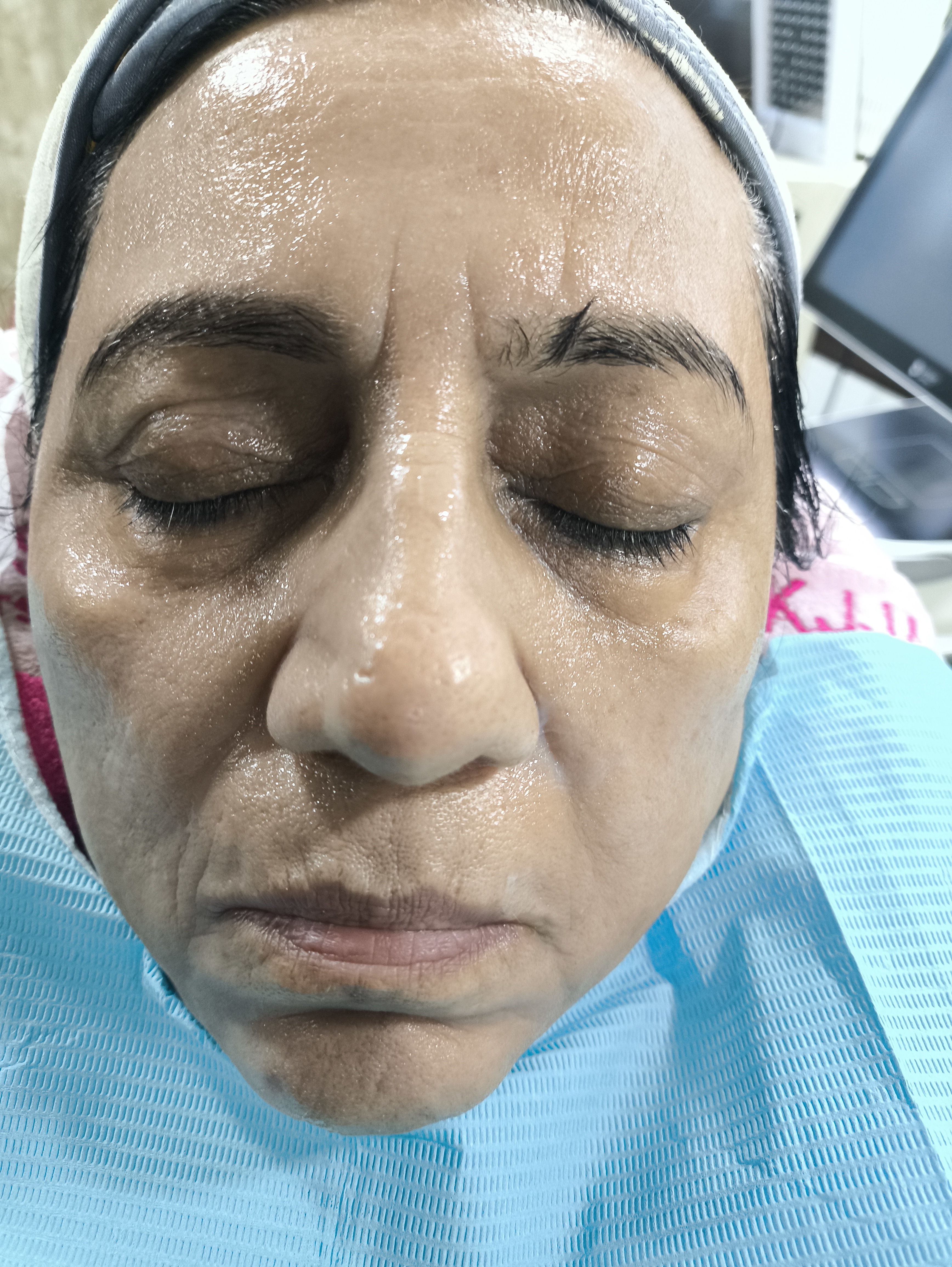 Medifacial treatment in Kolkata at Dontia Care Clinic Skin and Hair