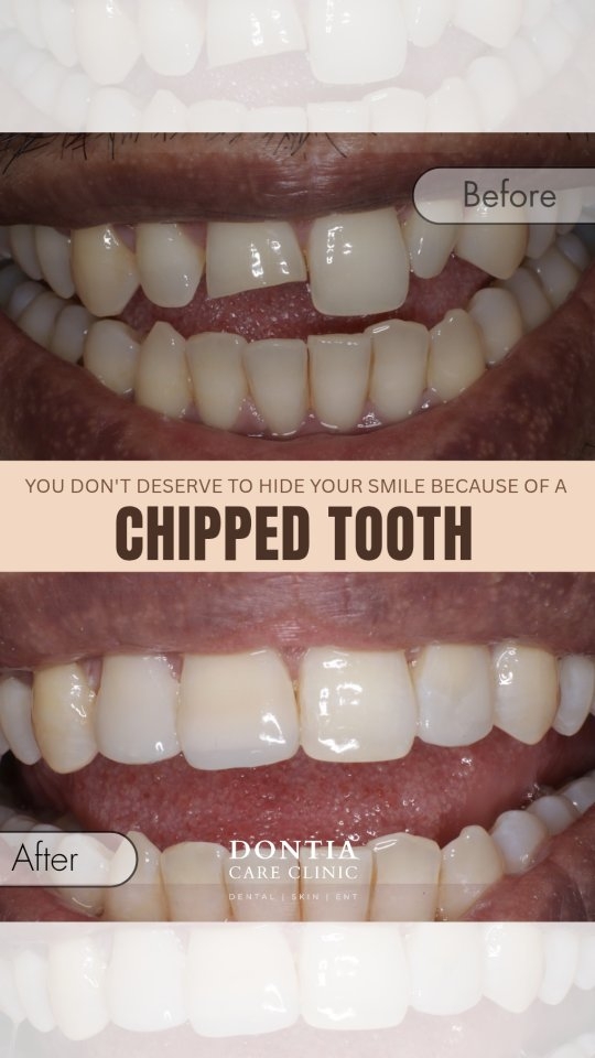 Chipped tooth veneer treatment before and after in Kolkata
