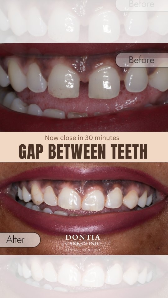 Gap between teeth veneer treatment before and after in Kolkata