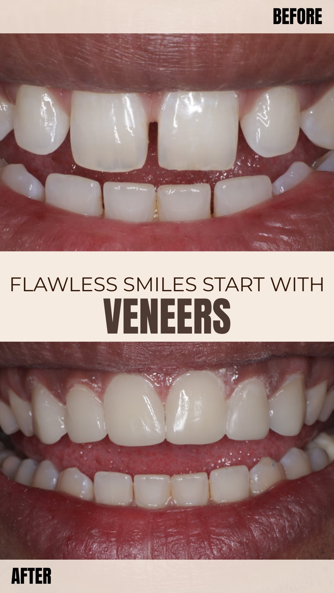 Cosmetic veneers for teeth gap closure before and after in Kolkata