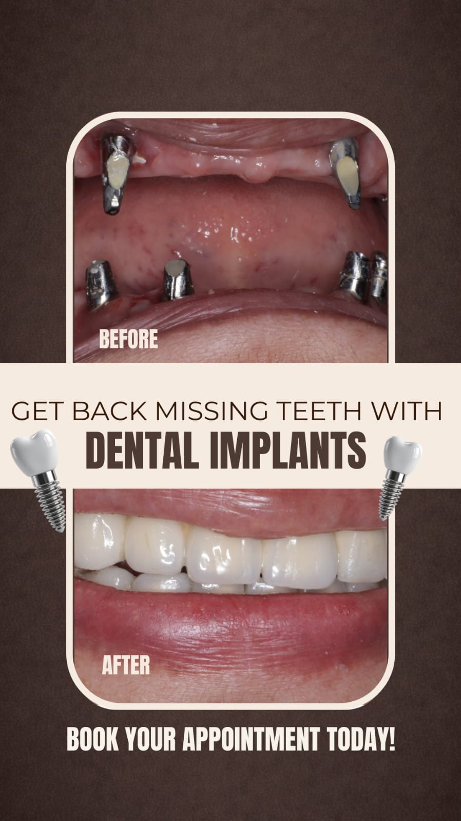 Dental implants case before and after in Kolkata