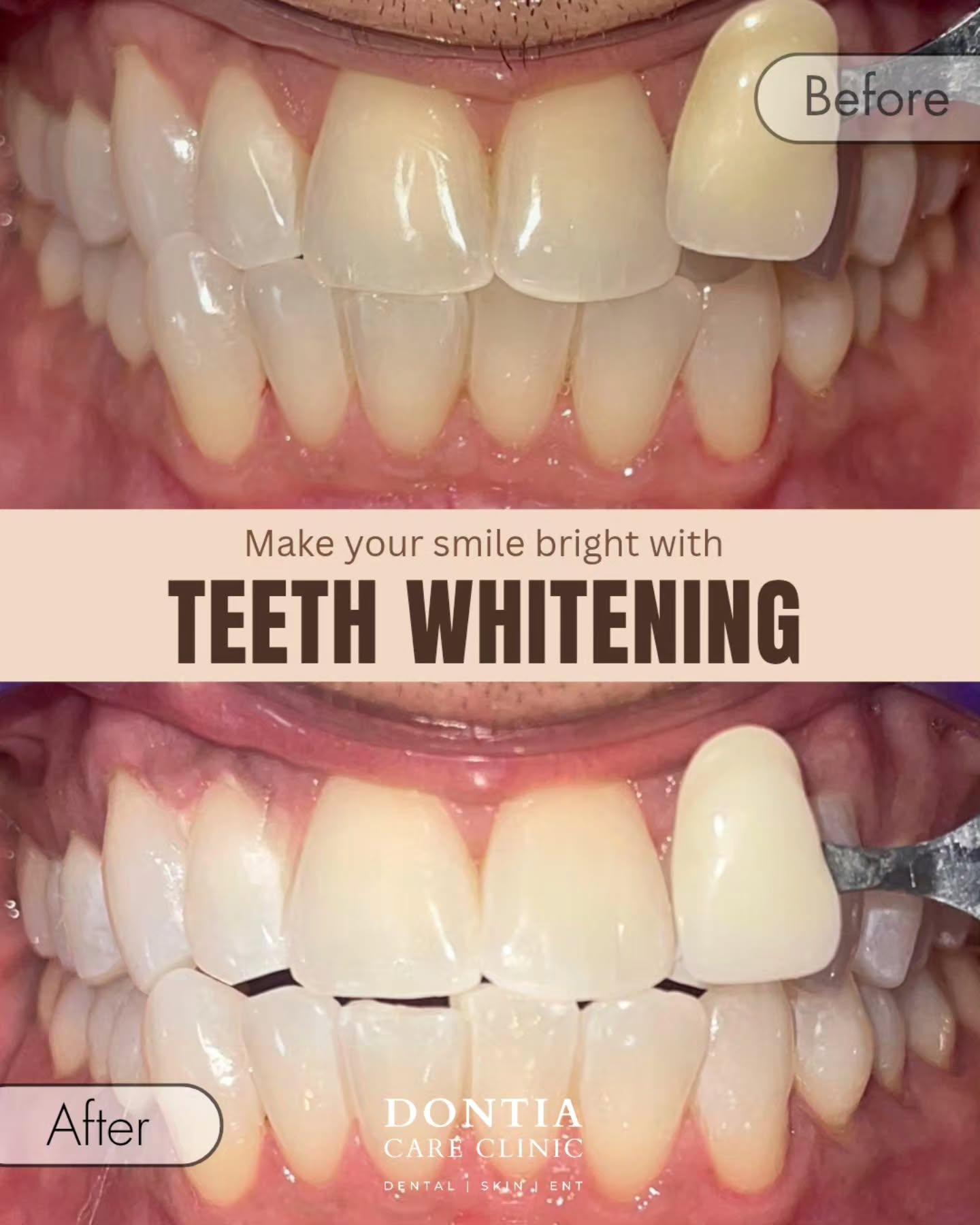 Teeth whitening treatment before and after in Kolkata